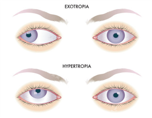 单眼斜视的样子图解