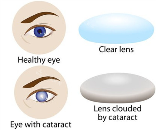 眼睛得了白内障的样子图解