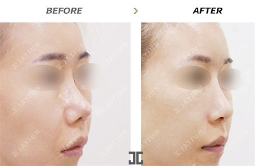 韩国JAYJUN整形鼻修复手术前后对比图