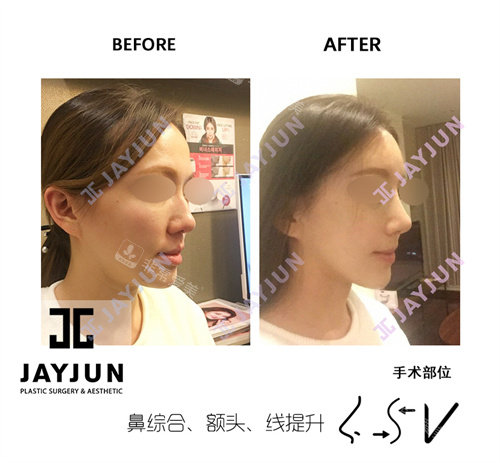 JAYJUN整形外科鼻子侧面