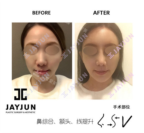 JAYJUN整形外科鼻综合正面