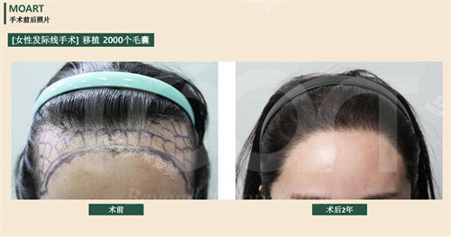 韩国moart毛发移植的对比正