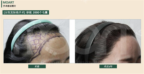 韩国moart毛发移植的前后对比侧面