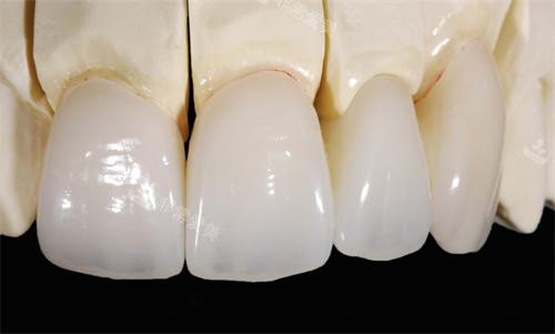 全瓷牙的光泽度和颜色都比较贴近真实牙齿