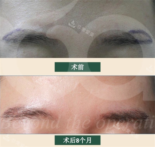 韓國moart毛發(fā)移植對(duì)比圖