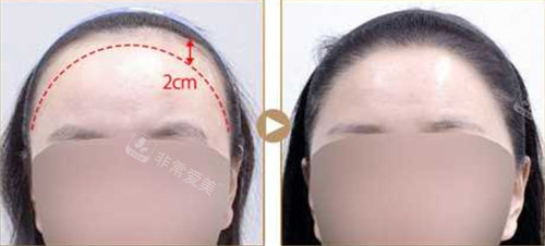 韩国Seojin整形外科植发对比图