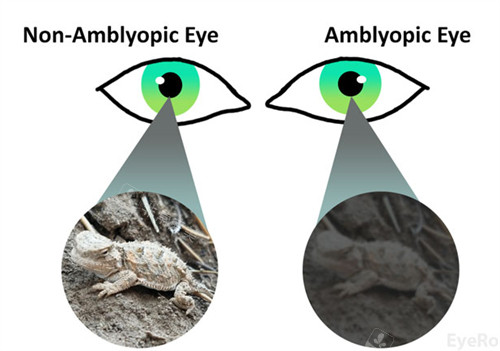 正常眼睛看到的物体和弱视看到的物体