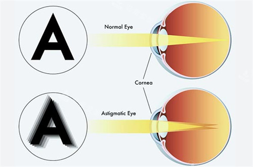 正常眼睛成像和弱视眼睛成像