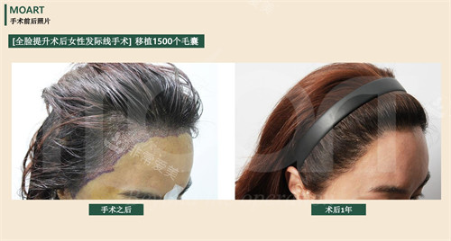 韩国moart毛发移植发际线手术前后对比图
