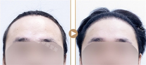 韩国Seojin整形外科植发对比图