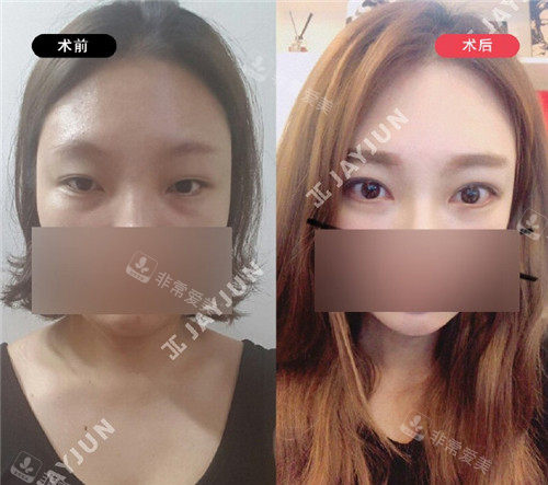 韓國jayjun整形眼部整形圖片 韓國jayjun整形眼部整形圖片