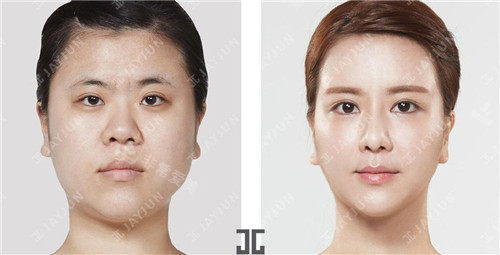 韓國jayjun面部整形圖