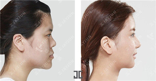 韓國jayjun整形面部填充照片