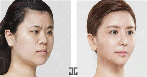韩国jayjun整形面部提升图片