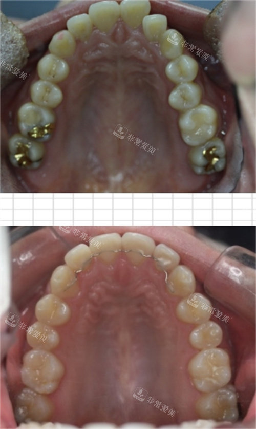 远程隐形矫正上牙