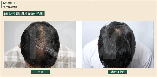 韩国moart毛发移植前后对比图