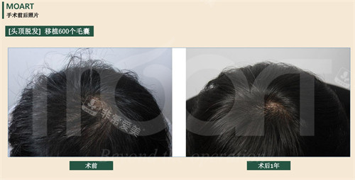 韩国moart毛发移植头顶脱发移植600毛囊前后对比图