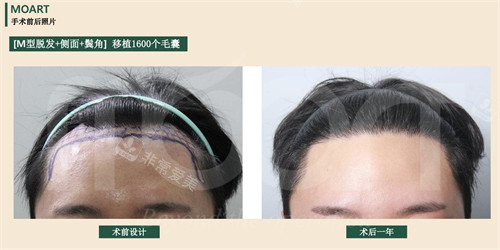 韩国moart毛发移植鬓角+发际线植发