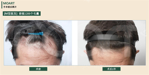 韩国moart毛发移植M型脱发植发前后对比图