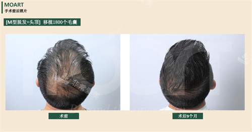 韩国moart毛发移植1800毛囊前后对比图