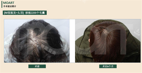 韩国moart毛发移植2200毛囊前后对比图