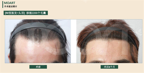韩国moart毛发移植发际线植发前后对比图