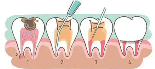 根管治疗动画步骤图
