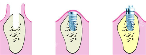 种植牙流程图