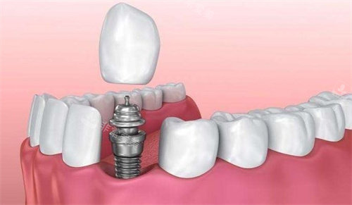 厦门种植牙多少钱一颗2023年?集采后2980元一颗很靠谱价更低!