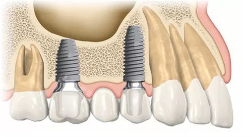 种植牙动画图