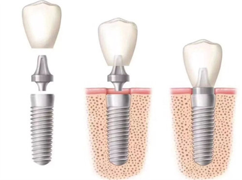 种植牙牙冠安装图