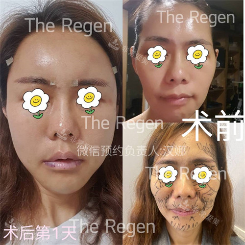 韓國(guó)JN整形外科磨骨手術(shù)對(duì)比照 韓國(guó)JN整形外科磨骨手術(shù)對(duì)比照