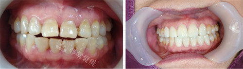 韩国D1牙科前牙美学修复图示