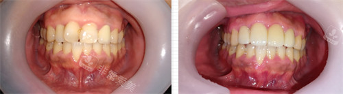 韩国D1牙科前牙修复前后图