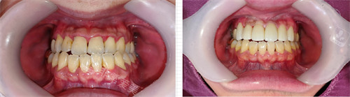 韩国D1牙科前牙美学修复对比
