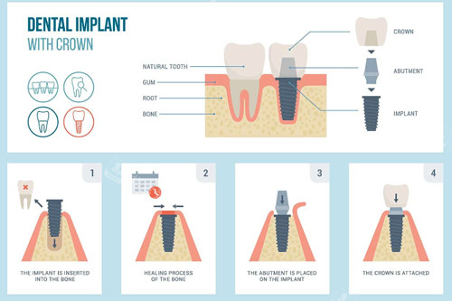 种植牙的种植过程图解