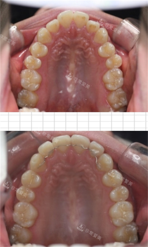 韩国D1牙科舌侧矫正对比图