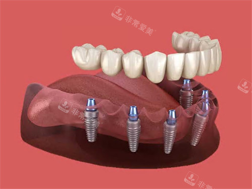 半口种植牙图示
