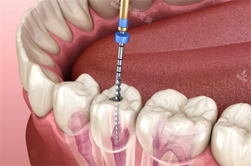 牙齿进行根管治疗