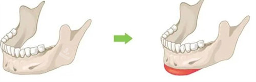 下巴植入 下巴植入