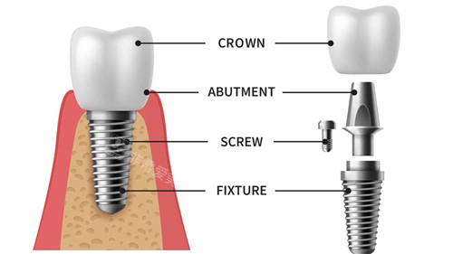 种植牙的组成部分展示
