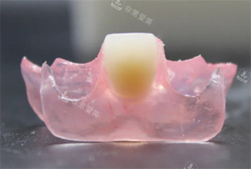 單顆牙修復(fù)照片 單顆牙修復(fù)照片