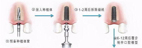 种植牙流程图