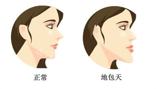 地包天的臉型 地包天的臉型