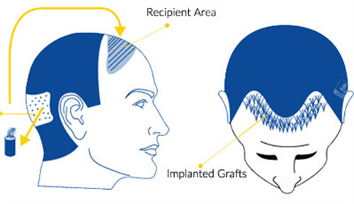 植发过程图解