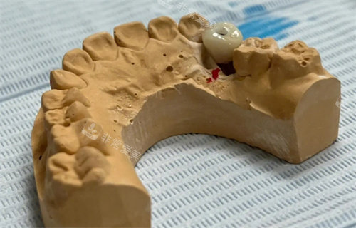 种植牙模型图