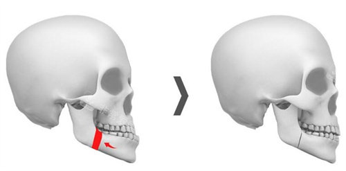 双鄂手术怎么做的