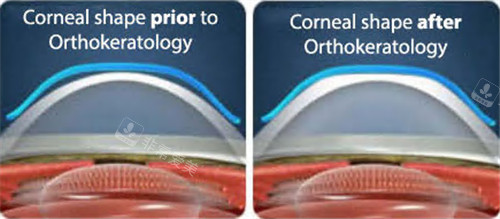 角膜塑形镜矫正图示
