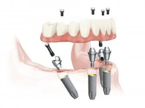 All-on-4种植过程图解