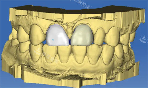 牙齿数字化修复图
